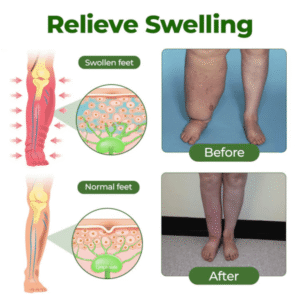 Relieflogix™ EDEMA RELIEF LOTION
