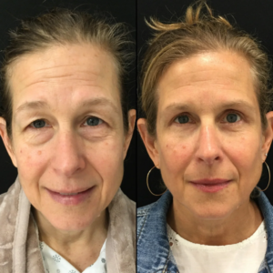 Bellavren™ | Visibly reduces wrinkles by up to 98% in just 17 minutes
