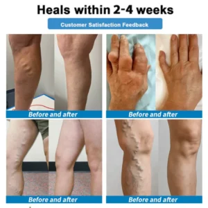 Healrize® 4-in-1 Vein & Joint Nano Microneedle Advanced Therapy Patch