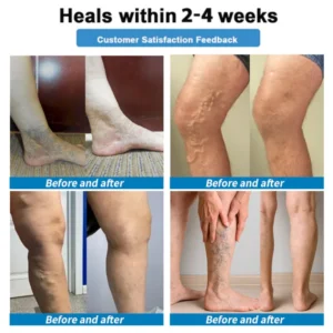 Healrize® 4-in-1 Vein & Joint Nano Microneedle Advanced Therapy Patch