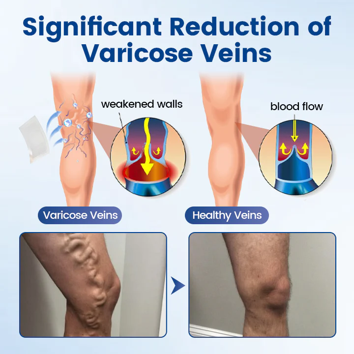 Timilk® Vein Ease Microneedle Therapy Patch