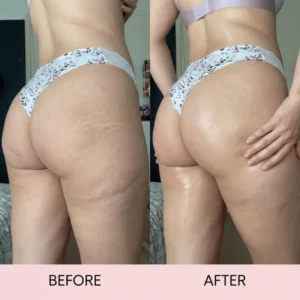FemKora Anti-Cellulite Massage Oil