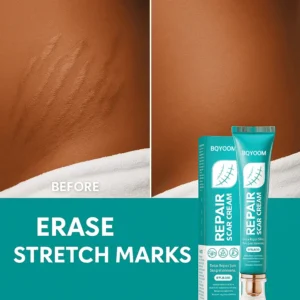 BQYOOM Scar Cream – Fade old scars, stretch marks & burns naturally