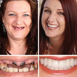 Yagoo™ Advanced Denture Kit Elevate Kit
