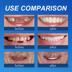KLENIMORE™ Medical Full Denture with Strong Suctiond