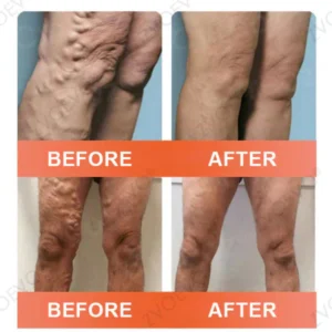 Zvoevo® Vein Ease Microneedle Care Patch