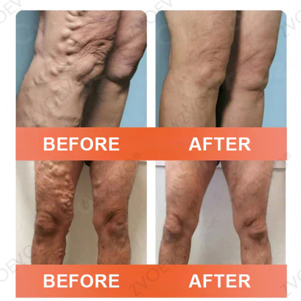 Zvoevo® Vein Ease Microneedle Care Patch