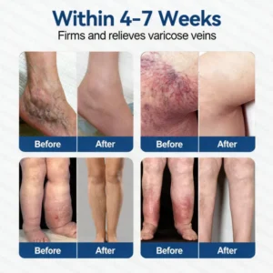 Glorenda® Vein Contour Microneedle Patch