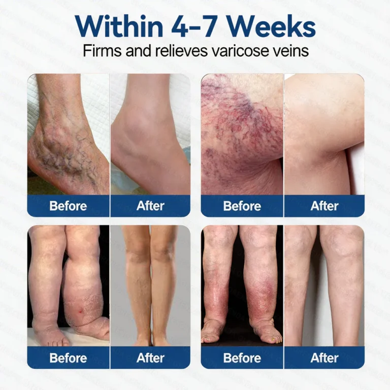 Glorenda® Vein Contour Microneedle Patch