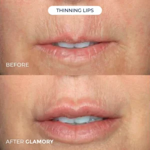 Glamory Microlift System