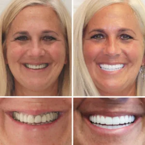 NESLEMY™ Advanced Customized Full Denture Set