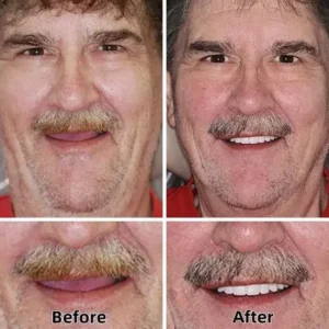 Laozik™ Advanced Custom-Fit Functional Dentures