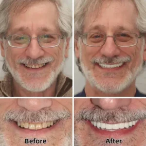 Laozik™ Advanced Custom-Fit Functional Dentures
