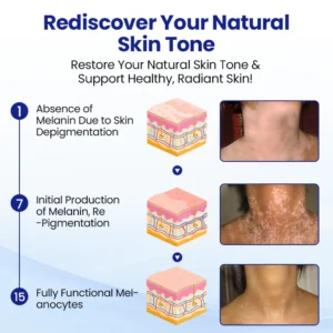 KUBOZN® Vitiligo Treatment Spray